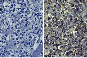 Paraffin embedded human kidney cancer tissue was stained with Mouse IgG1-UNLB isotype control followed by HRP conjugated Anti-Mouse Ig secondary antibody, DAB, and hematoxylin. (MMP2 antibody)