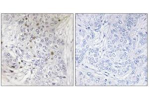Immunohistochemistry analysis of paraffin-embedded human breast carcinoma tissue, using MAFF antibody. (MafF antibody  (Internal Region))