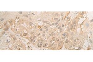 Immunohistochemistry of paraffin-embedded Human esophagus cancer tissue using DROSHA Polyclonal Antibody at dilution of 1:45(x200)