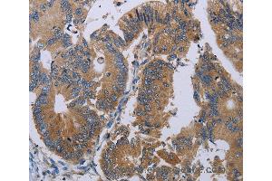 Immunohistochemistry of Human colon cancer using PRKD3 Polyclonal Antibody at dilution of 1:50 (PRKD3 antibody)