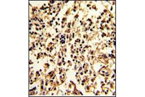 Formalin-Fixed, Paraffin-Embedded Human lymph with SERPINA9 Antibody (Center), which was peroxidase-conjugated to the secondary antibody, followed by DAB staining. (SERPINA9 antibody  (Middle Region))