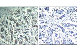 Immunohistochemical analysis of paraffin-embedded human breast carcinoma tissue using PLC-γ1 (Ab-771) Antibody (E021523). (Phospholipase C gamma 1 antibody)