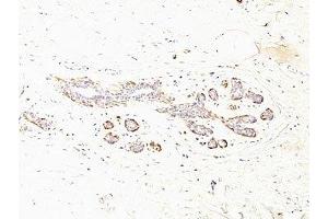 Formalin-fixed, paraffin-embedded human breast carcinoma stained with SMMHC antibody (MYH11/923 + SMMS-1).