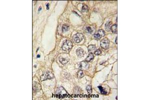 Formalin-fixed and paraffin-embedded human hepatocarcinoma tissue reacted with CDH6 antibody , which was peroxidase-conjugated to the secondary antibody, followed by DAB staining. (CDH6 antibody  (C-Term))
