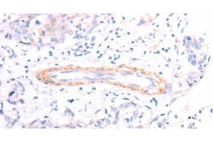 Immunohistochemistry of paraffin-embedded Human breast cancer using TPM1 Polyclonal Antibody at dilution of 1:40 (Tropomyosin antibody)