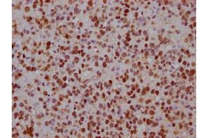 IHC image of ABIN7152619 diluted at 1:100 and staining in paraffin-embedded human glioma cancer performed on a Leica BondTM system. (FABP4 antibody  (AA 6-132))
