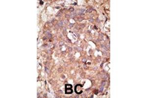 Formalin-fixed and paraffin-embedded human cancer tissue reacted with the primary antibody, which was peroxidase-conjugated to the secondary antibody, followed by DAB staining. (NUB1 antibody  (C-Term))