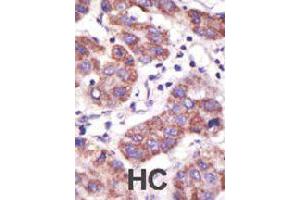 Formalin-fixed and paraffin-embedded human hepatocellular carcinoma tissue reacted with USP3 polyclonal antibody  , which was peroxidase-conjugated to the secondary antibody, followed by DAB staining. (USP3 antibody  (N-Term))
