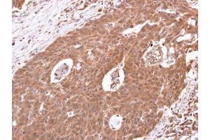 IHC-P Image beta 2 Adrenergic Receptor antibody [C2C3], C-term detects beta 2 Adrenergic Receptor protein at cytosol on human colon carcinoma by immunohistochemical analysis. (beta 2 Adrenergic Receptor antibody  (C-Term))