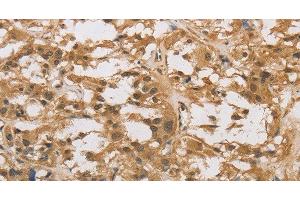 Immunohistochemistry of paraffin-embedded Human thyroid cancer using DAB2 Polyclonal Antibody at dilution of 1:30 (DAB2 antibody)