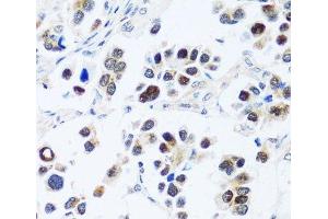 Immunohistochemistry of paraffin-embedded Human lung cancer using BRIX1 Polyclonal Antibody at dilution of 1:100 (40x lens). (BRIX1 antibody)
