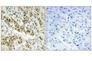 Immunohistochemistry analysis of paraffin-embedded human breast carcinoma tissue using CtBP1 (Ab-422) antibody. (CTBP1 antibody  (Ser422))