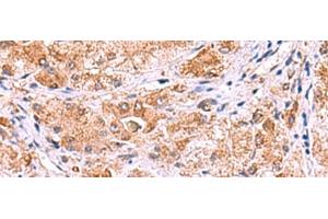 Immunohistochemistry of paraffin-embedded Human liver cancer tissue using UXS1 Polyclonal Antibody at dilution of 1:60(x200) (UXS1 antibody)