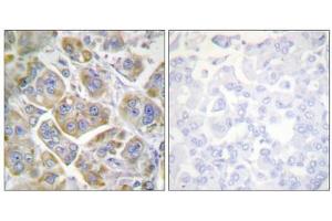 Immunohistochemistry analysis of paraffin-embedded human breast carcinoma tissue using ITGB4 (epitope around residue 1510) antibody. (Integrin beta 4 antibody  (Tyr1510))