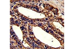 IHC analysis of FFPE human prostate carcinoma stained with ORAI1 antibody (ORAI1 antibody  (AA 145-173))