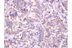 Formalin-fixed and paraffin embedded human lung carcinoma labeled with Anti-CD55/DAF Polyclonal Antibody, Unconjugated  at 1:200 followed by conjugation to the secondary antibody and DAB staining.