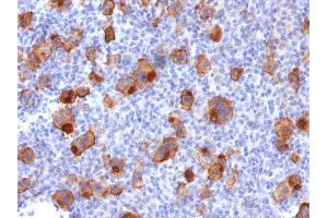 Formalin-fixed, paraffin-embedded human Hodgkin's Lymphoma stained with CD30 Rabbit Recombinant Monoclonal Antibody (Ki-1/1747R).