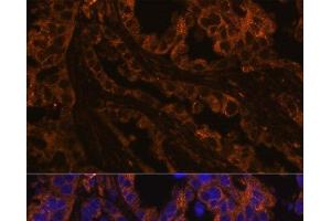 Immunofluorescence analysis of Human lung cancer cells using KRT7 Polyclonal Antibody at dilution of 1:100. (Cytokeratin 7 antibody)