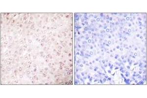 Immunohistochemistry analysis of paraffin-embedded human breast carcinoma tissue, using p300/CBP Antibody.