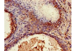 Immunohistochemistry of paraffin-embedded human prostate cancer using ABIN7145421 at dilution of 1:100 (beta-2 Microglobulin antibody  (AA 21-119))