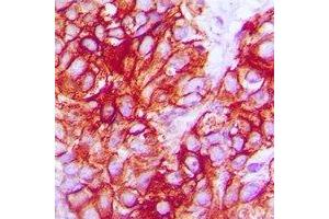 Immunohistochemical analysis of TRK B staining in human breast cancer formalin fixed paraffin embedded tissue section.
