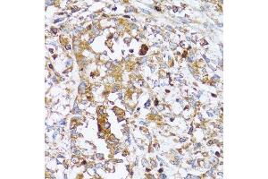 Immunohistochemistry of paraffin-embedded human uterine cancer using ACTR2 antibody. (ACTR2 antibody  (AA 1-160))