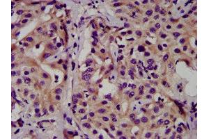 IHC image of ABIN7146788 diluted at 1:500 and staining in paraffin-embedded human liver cancer performed on a Leica BondTM system. (CEACAM16 antibody  (AA 323-414))
