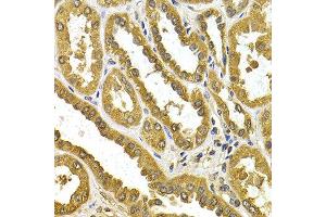 Immunohistochemistry of paraffin-embedded human kidney cancer using UGT1A4 antibody at dilution of 1:200 (400x lens). (UGT1A4 antibody)