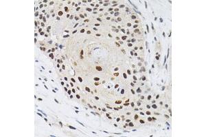 Immunohistochemistry of paraffin-embedded human esophageal cancer using KPNA4 Antibody (ABIN5971058) at dilution of 1/200 (40x lens). (KPNA4 antibody)