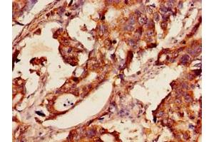Immunohistochemistry of paraffin-embedded human gastric cancer using ABIN7154080 at dilution of 1:100 (Glutathione Reductase antibody  (AA 47-219))