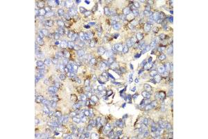 Immunohistochemistry of paraffin-embedded human prostate cancer using TFAM antibody (ABIN6290990) at dilution of 1:100 (40x lens).