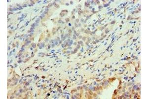 Immunohistochemistry of paraffin-embedded human lung cancer using ABIN7162505 at dilution of 1:100
