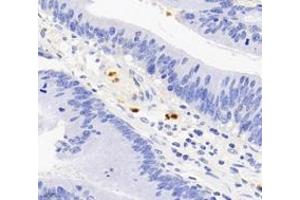 Immunohistochemistry analysis of paraffin-embedded human colon cancer using S100A12 (ABIN7075493) at dilution of 1: 4000 (S100A12 antibody)