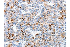 The image on the left is immunohistochemistry of paraffin-embedded Human liver cancer tissue using ABIN7128970(CLIP1 Antibody) at dilution 1/30, on the right is treated with fusion protein. (CLIP1 antibody)