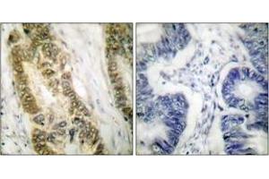 Immunohistochemistry analysis of paraffin-embedded human colon carcinoma tissue, using SP1 (Ab-739) Antibody. (SP1 antibody  (AA 706-755))