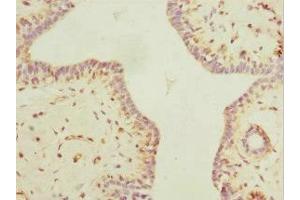 Immunohistochemistry of paraffin-embedded human breast cancer using ABIN7160535 at dilution of 1:100 (MYLK3 antibody  (AA 1-240))