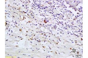 Formalin-fixed and paraffin embedded human breast carcinoma labeled with Anti- TLR5 Polyclonal Antibody, Unconjugated (ABIN673239) at 1:200 followed by conjugation to the secondary antibody and DAB staining (TLR5 antibody  (AA 701-810))
