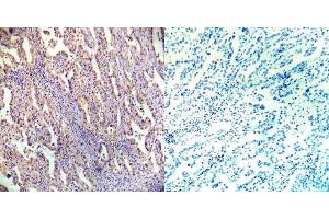 Immunohistochemical analysis of paraffin- embedded human lung carcinoma tissue using AMPKbeta1 (Ab-182) antibody (E022004). (PRKAB1 antibody)