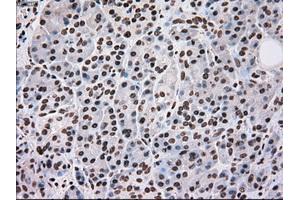 Immunohistochemical staining of paraffin-embedded Adenocarcinoma of breast tissue using anti-SCYL3 mouse monoclonal antibody.