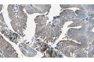ABIN6277239 at 1/100 staining Human cervical cancer tissue by IHC-P. (SERPINH1 antibody  (Internal Region))