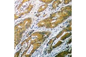 Immunohistochemical analysis of B4GALT1 staining in human colon cancer formalin fixed paraffin embedded tissue section. (B4GALT1 antibody  (C-Term))