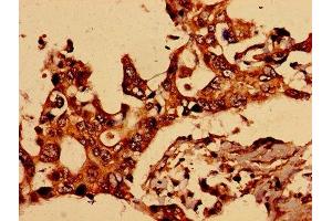 Immunohistochemistry of paraffin-embedded human pancreatic cancer using ABIN7153987 at dilution of 1:100 (NMDAR2A antibody  (AA 501-750))