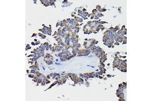 Immunohistochemistry of paraffin-embedded human thyroid cancer using GSTK1 Rabbit pAb (ABIN1680136, ABIN3019398, ABIN3019399 and ABIN6220875) at dilution of 1:25 (40x lens). (GSTK1 antibody  (AA 1-226))
