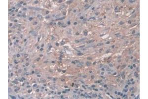 DAB staining on IHC-P; Samples: Human Breast cancer Tissue (Cathepsin Z antibody  (AA 24-303))