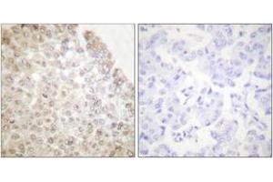 Immunohistochemistry analysis of paraffin-embedded human breast carcinoma tissue, using HDAC5 Antibody. (HDAC5 antibody  (AA 1073-1122))