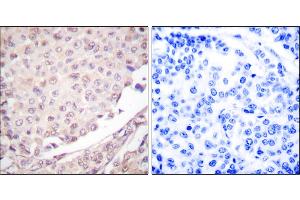 Immunohistochemical analysis of paraffin-embedded human lung carcinoma tissue using Cullin 1 antibody. (Cullin 1 antibody)
