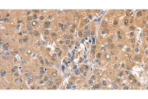 Immunohistochemistry of paraffin-embedded Human liver cancer using CIAPIN1 Polyclonal Antibody at dilution of 1:60 (CIAPIN1 antibody)