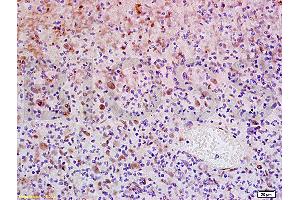 Formalin-fixed and paraffin embedded human glioma tissue labeled with Anti-WIG-1/PAG608 Polyclonal Antibody, Unconjugated (ABIN730108) at 1:200, followed by conjugation to the secondary antibody and DAB staining (ZMAT3 antibody  (AA 201-288))