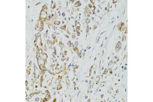 Immunohistochemistry of paraffin-embedded human gastric cancer using DICER1 antibody (ABIN5973583) at dilution of 1/100 (40x lens). (DICER1 antibody)