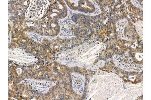 ABIN7095475 and ABIN7099532 at 1/100 staining human lung cancer by IHC-P.